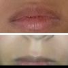 labios aumento fatal - 5763