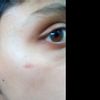 cicatriz rojiza en el rostro - 5989