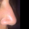 Cirugía nasal Rinoplastia - 6055