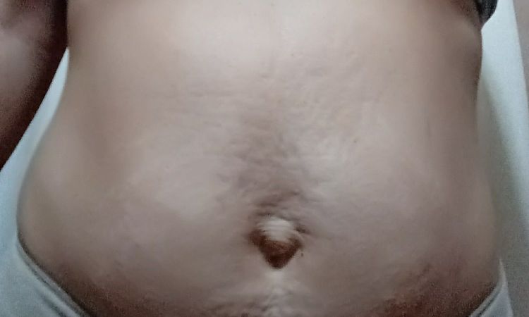 Abdominoplastía y esclerosis múltiple - 6112