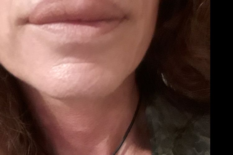 Extraccion de bíopolímeros en los labios..Agradecería mucho su respuesta.