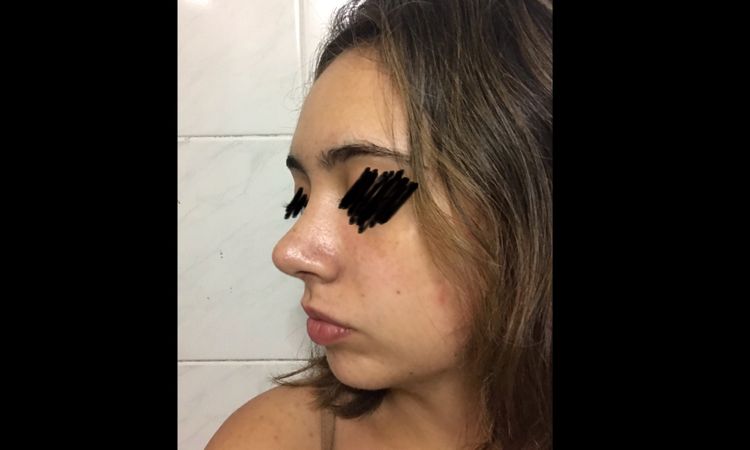 Me hice una rinoplastia, pero veo mi nariz demasiado proyectada - 6128