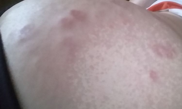 Tengo biopolimero en mis nalgas - 6207