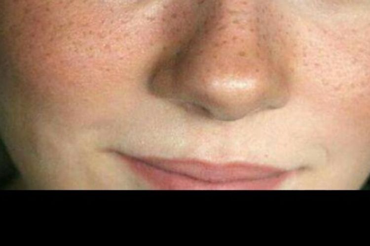 Pecas y micropigmentacion