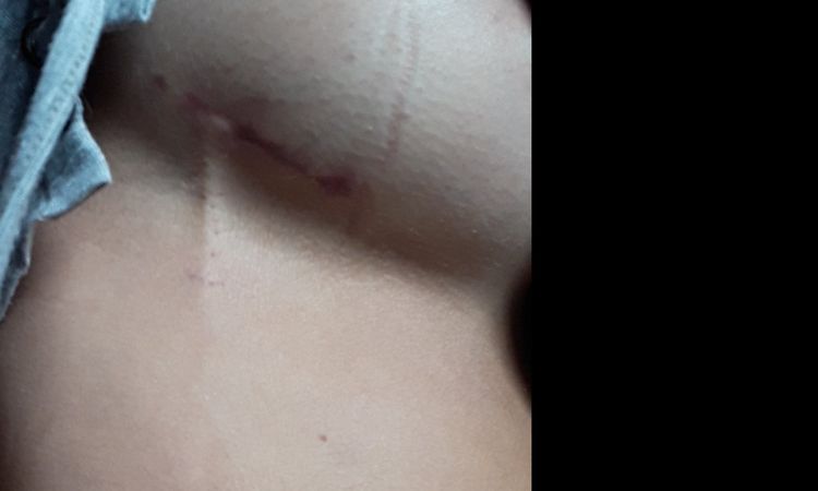 Vena inflamado dejajo de la mama derecha - 6415