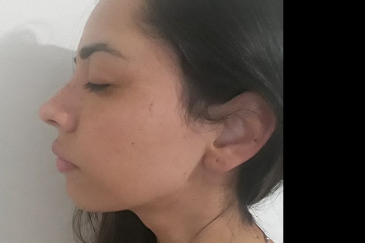perfiloplastia sin cirugia