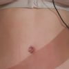 Ombligo despues lipectomia