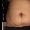 Lipo vaser ¿evita la dermolipectomia ?