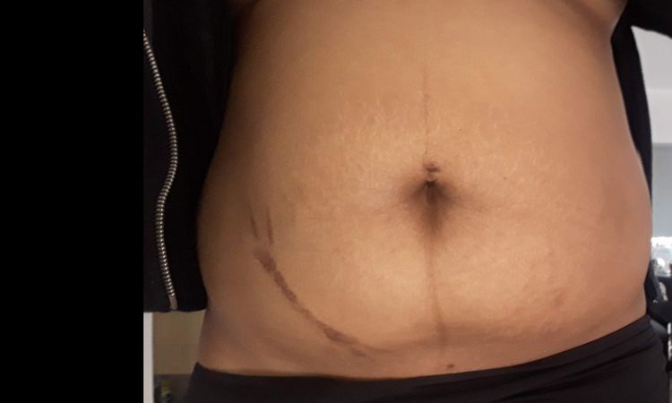 Lipo vaser ¿evita la dermolipectomia ? - 7519