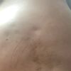 Venus freeze y lipotransferencia
