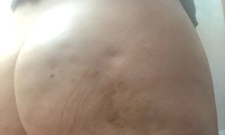 Venus freeze y lipotransferencia - 7676