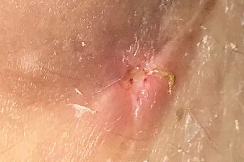 Cómo darme cuenta si se me abrió un punto o está infectado - 7911