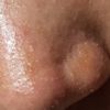 Me queme con el sol la nariz después de rinoplastia