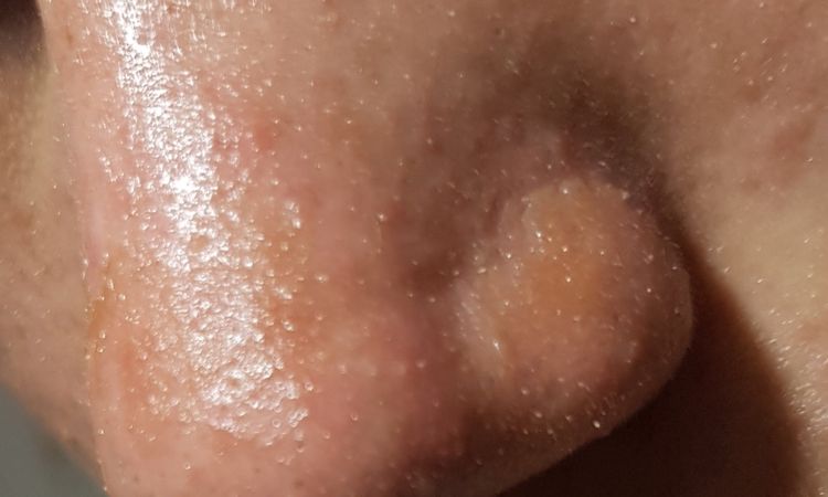 Me queme con el sol la nariz después de rinoplastia - 8336