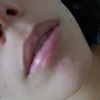 Cicatriz en el labio inferior - 8437
