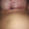 Consecuencias de seroma en mi mastopexia