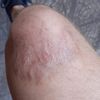 Grande cicatriz roja en mi rodilla - 12080