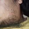 Implante cabello barba