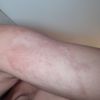 Algun tratamiento para cicatriz de quemadura manchada? - 12206