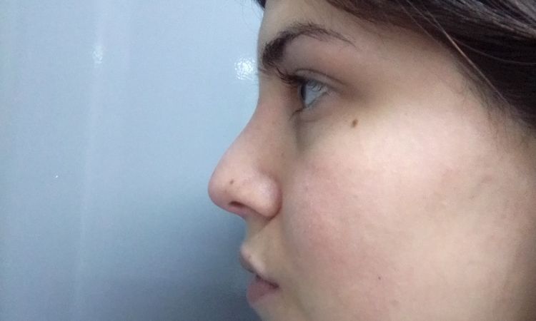 Rinoplastia después de 2 meses - 12542