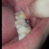 Un pedazo de muela suelto requiere de cirugía?