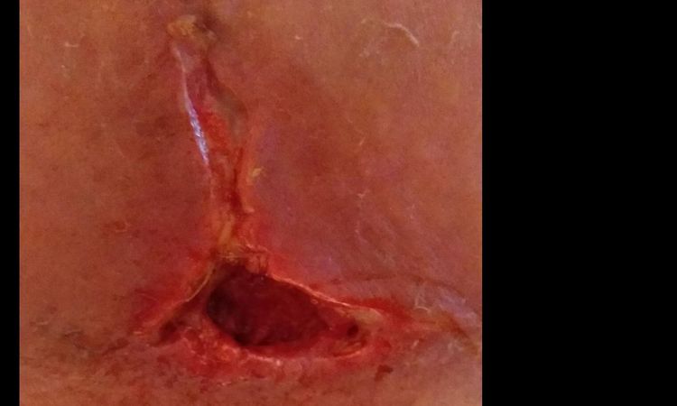 Se me abrio la cirugia de la abdominoplastia - 15416