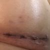Cicatriz costra aumento mamario 15 días post operatorio