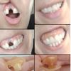Implante dental con complicaciones - 15984