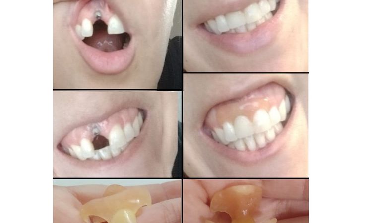 Implante dental con complicaciones - 15984