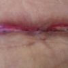 Fibrina en cicatriz de abdominoplastía