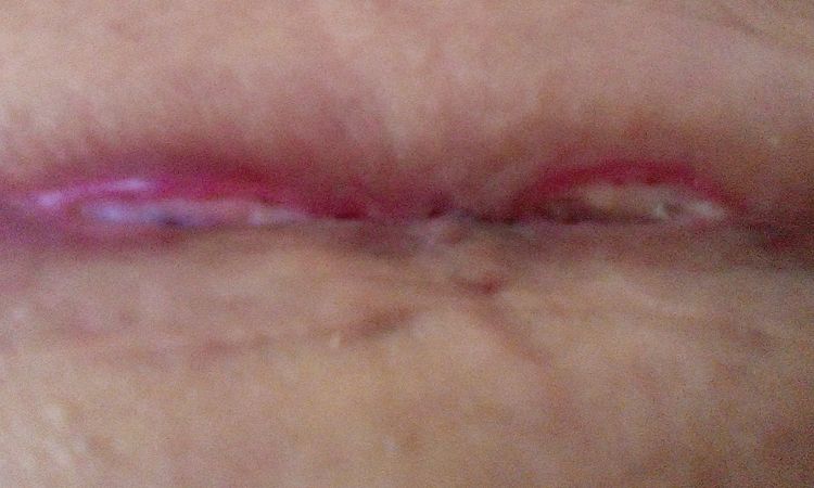 Fibrina en cicatriz de abdominoplastía - 16053