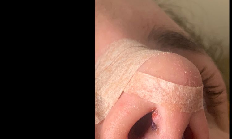 Posible granuloma de sutura - 16163