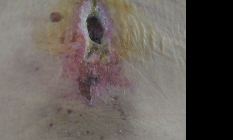 No se cura mi ombligo necrosado - 32651