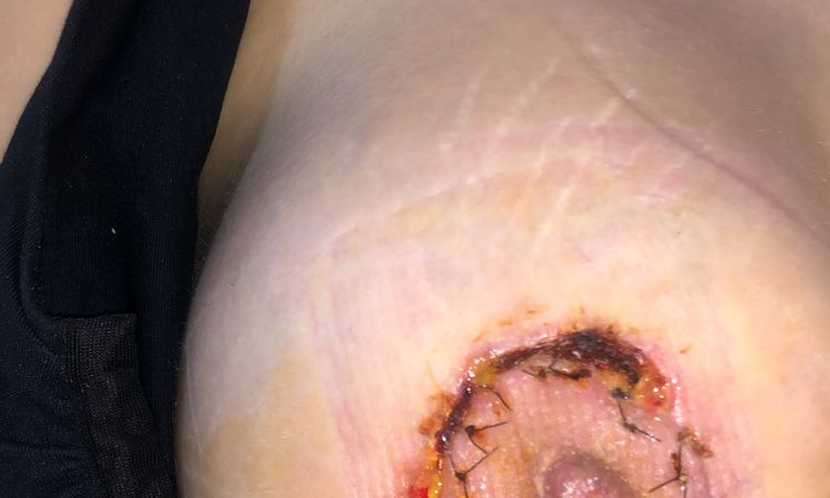 Heridas abiertas en areolas tras mastopexia (no se recupera la piel) - 45515
