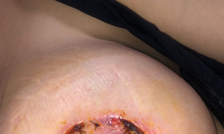 Heridas abiertas en areolas tras mastopexia (no se recupera la piel) - 45516