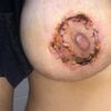 Heridas Mastopexia que empeoran