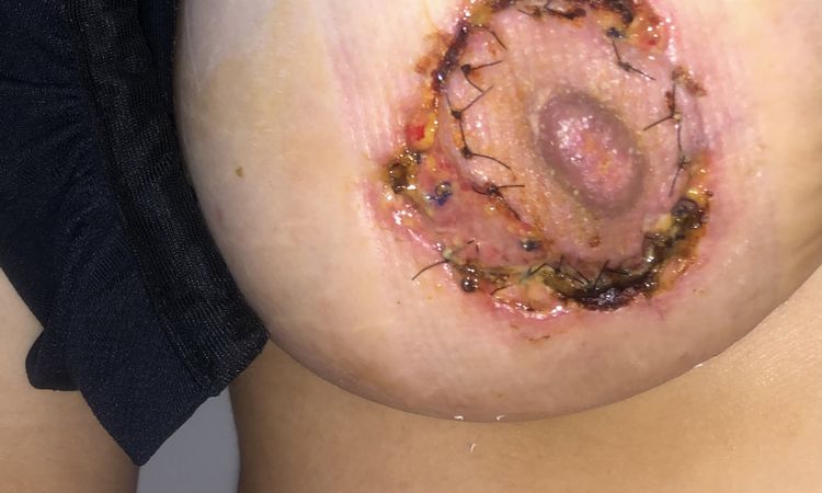 Heridas Mastopexia que empeoran - 45550
