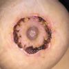 Heridas Mastopexia que empeoran