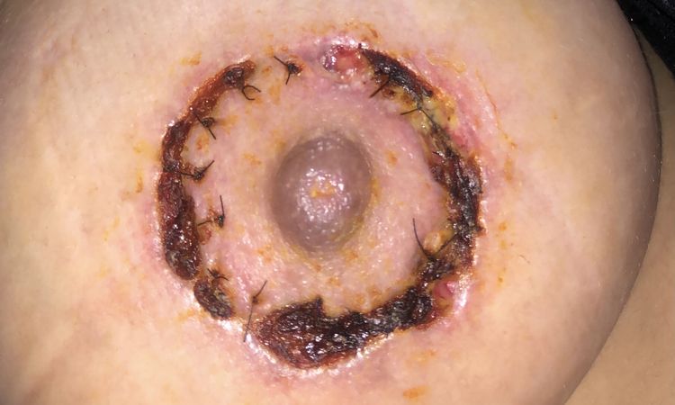 Heridas Mastopexia que empeoran - 45551