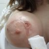Herida abierta en areola cuando me sacaron los puntos