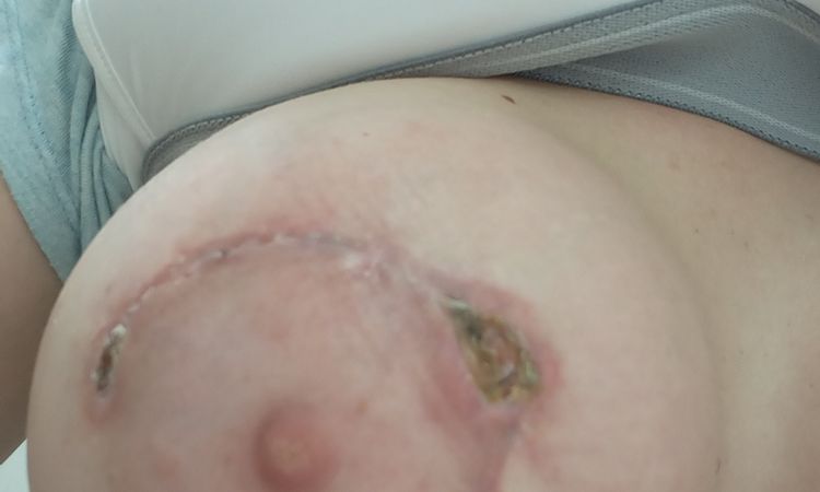 Herida abierta en areola cuando me sacaron los puntos - 45611