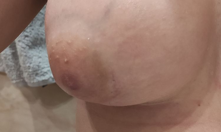 Complejo areola-pezón bajo y mirando al exterior tras aumento de mamas - 46532