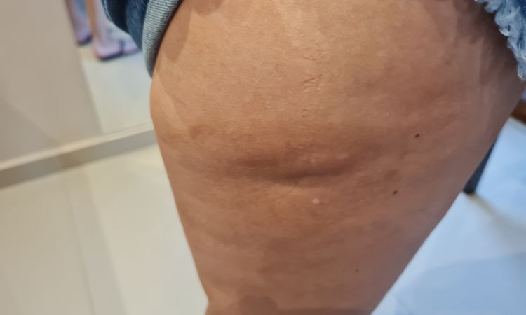 Bulto tras incisión en rodilla - 46819