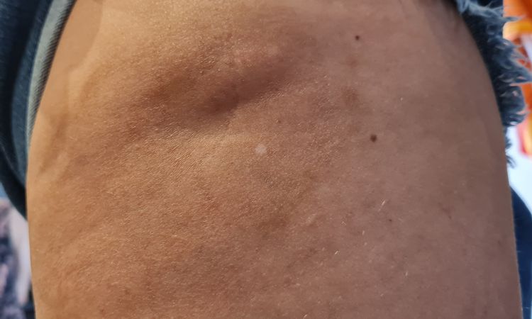 Bulto tras incisión en rodilla - 46820