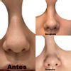 Fibrosis y nariz levantada post rinoplastia - 46895