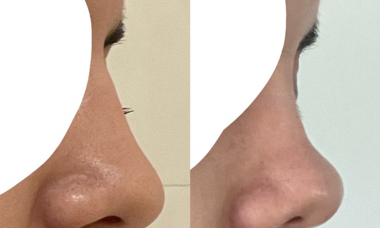 Fibrosis y nariz levantada post rinoplastia - 46896