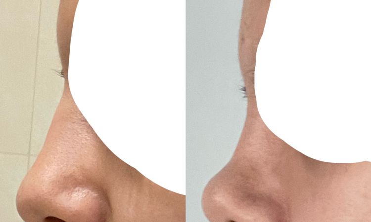 Fibrosis y nariz levantada post rinoplastia - 46897