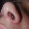 Bola extraña en fosa nasal tras rinoplastia - 47175