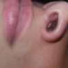 Bola extraña en fosa nasal tras rinoplastia