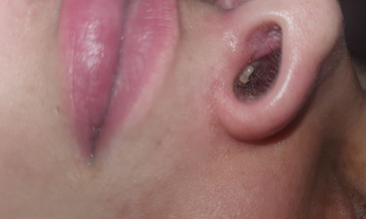 Bola extraña en fosa nasal tras rinoplastia - 47176